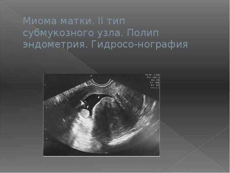 Миомэктомия