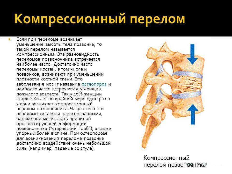 Компрессионный перелом 12 позвонка грудного отдела позвоночника  Компрессионный перелом позвоночника в грудном отделе  Компрессионный перелом позвоночника