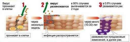 Впч 39 типа методы диагностики и медикаментозное лечение | mma-spb.ru