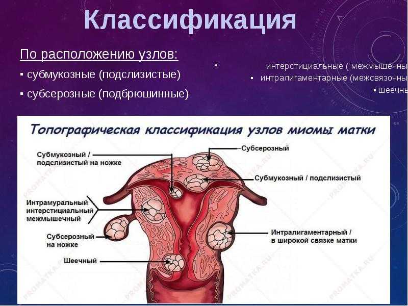 Виды миомы матки — классификация по расположению узлов и размерам опухоли с фото