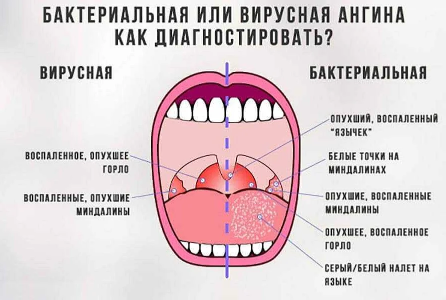 Болит горло с правой, с левой стороны