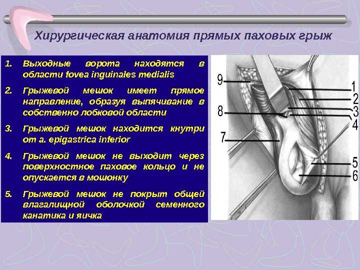 Паховая грыжа у женщин • русский доктор