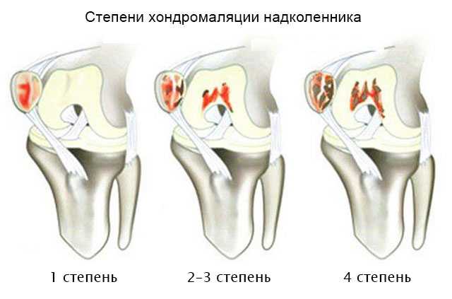 Классификация, проявления и терапия хондромаляции мыщелков бедренной кости  Классификация, проявления и терапия хондромаляции мыщелков бедренной кости
