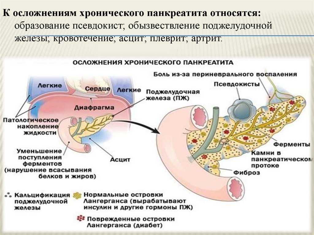 Методы удаления поджелудочной железы и последствия