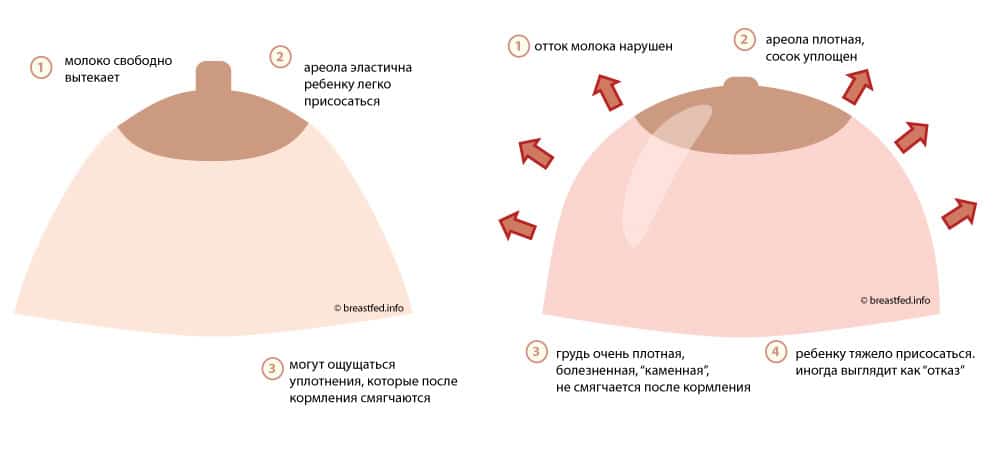 Перестала болеть грудь при беременности — причины. на каком сроке беременности перестает болеть грудь