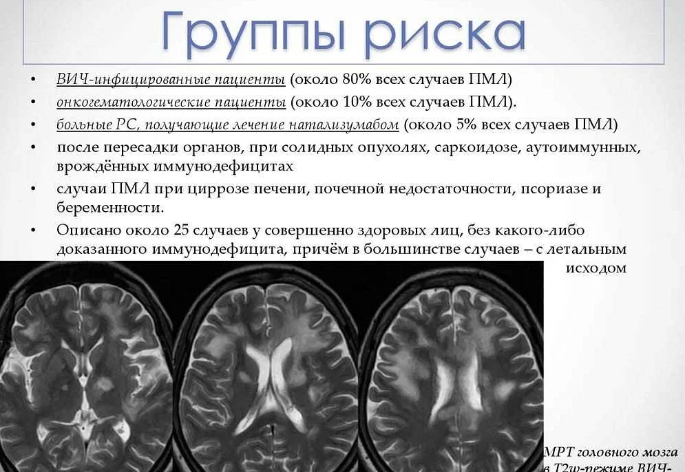 Перивентрикулярный лейкоареоз: причины, симптомы и лечение