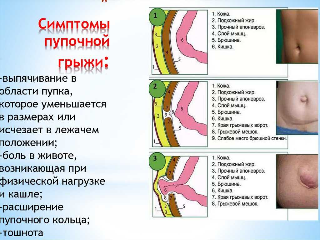 Как лечить пупочную грыжу во время беременности — способы устранения недуга  профилактические меры  Как лечить пупочную грыжу во время беременности —