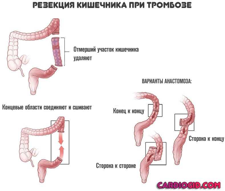 Резекция кишечника, операция по удалению кишки: показания, ход, реабилитация