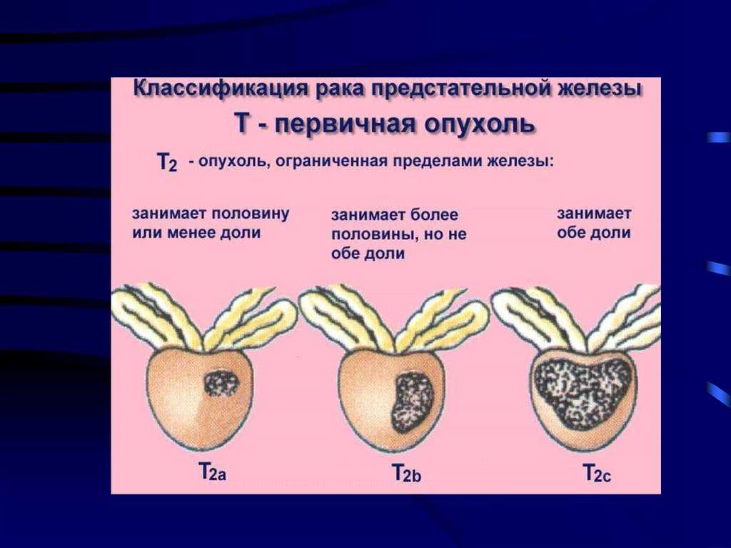 Лучевая терапия при раке предстательной железы: последствия и реабилитация