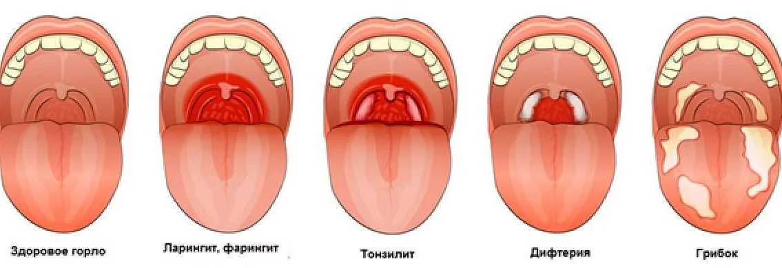 Почему болит горло с одной стороны