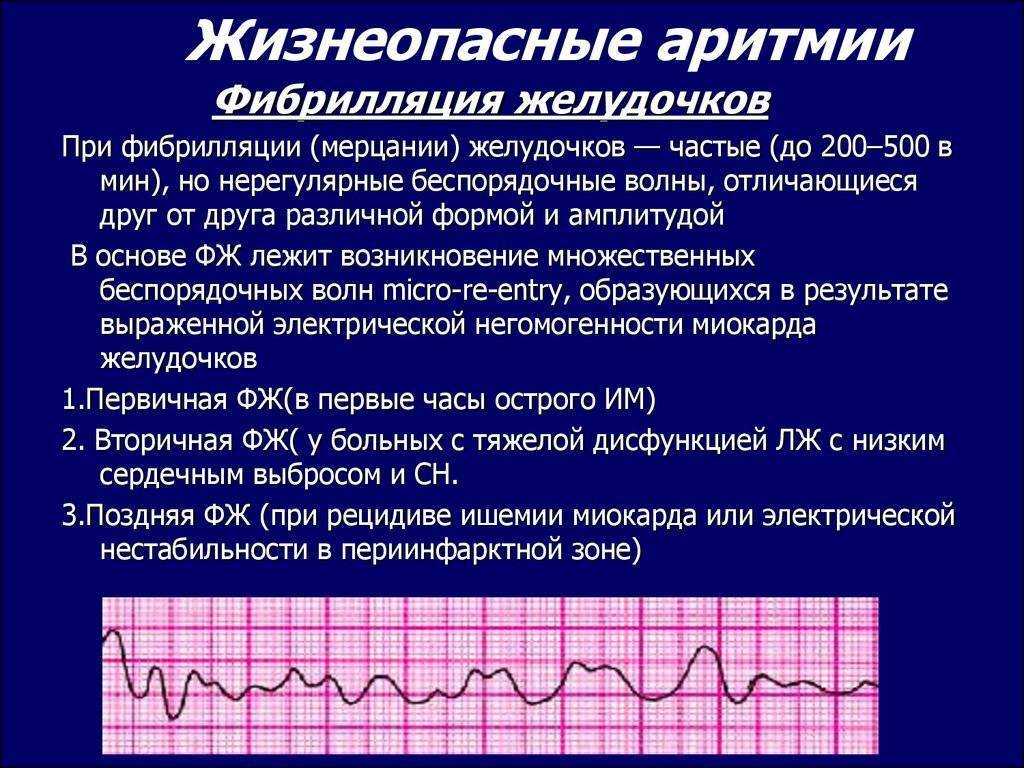 Частая мономорфная желудочковая экстрасистолия