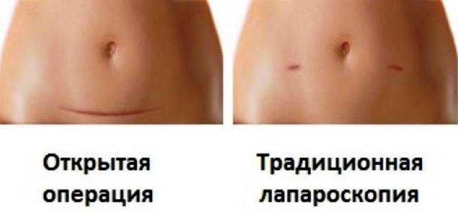 Что ждет женщину после удаления матки и яичников %sep% +мама
