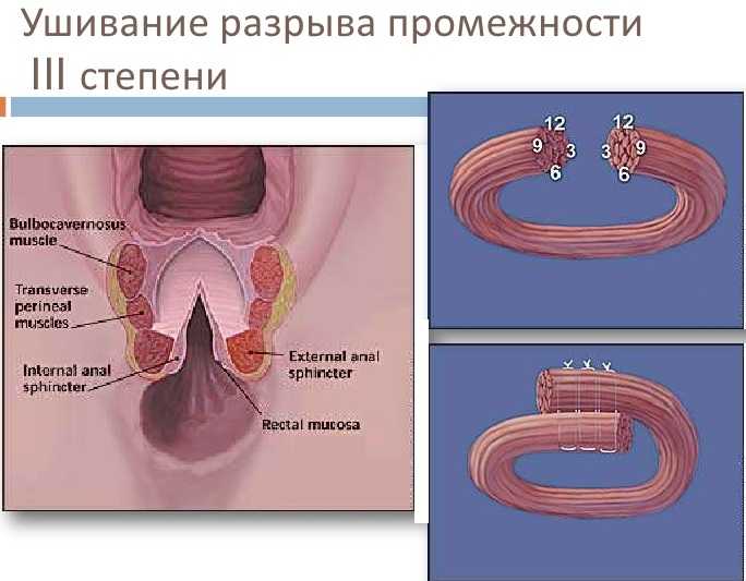 Эпизиотомия и «акушерская совесть» - центр семейных родов «радуга»