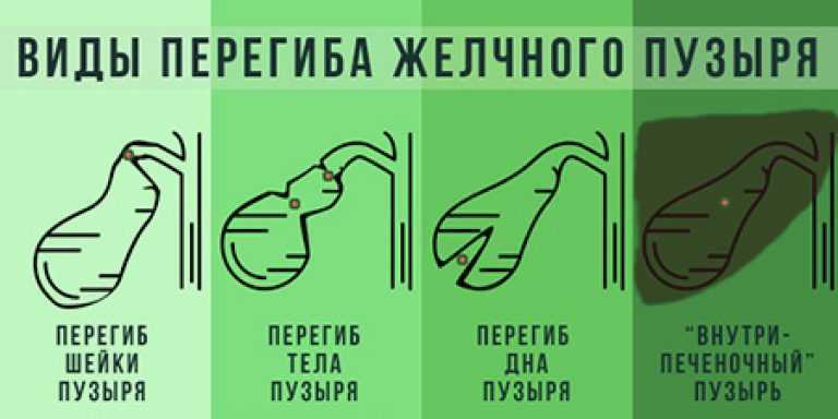 Перегиб и перетяжка желчного пузыря: причины, симптомы, лечение