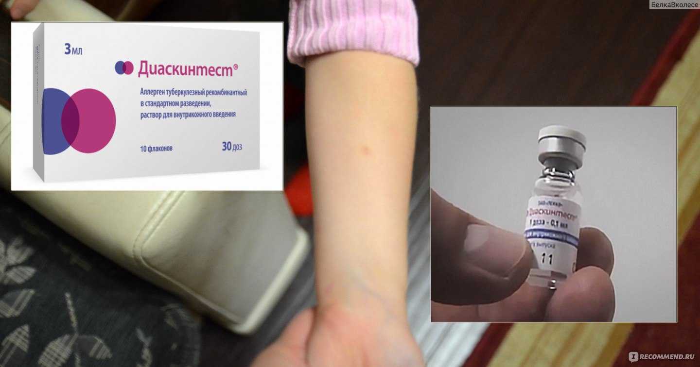 Тесты вместо манту: виды, эффективность, преимущества и недостатки