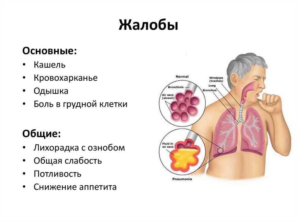 Кашель после физической нагрузки (бега и упражнений) у ребенка | prof-medstail.ru