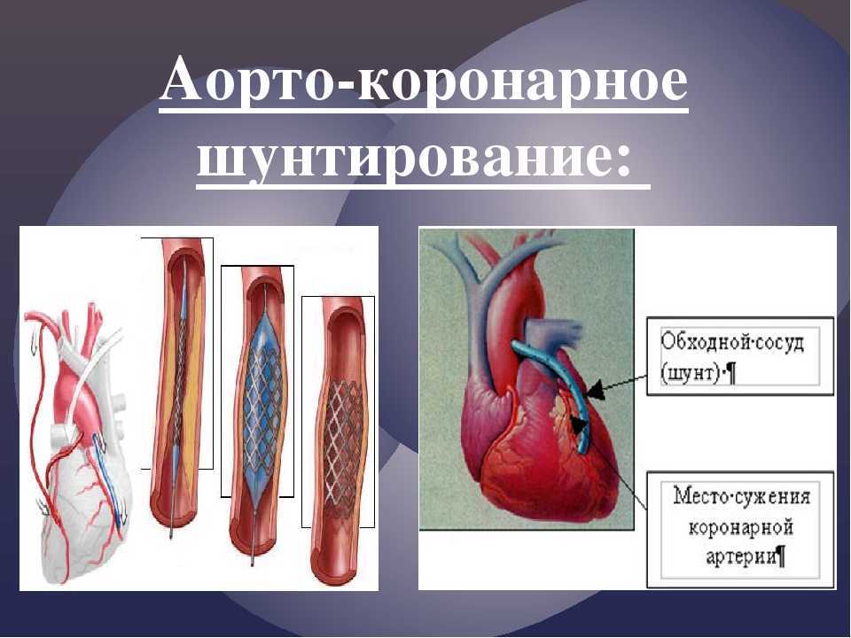 Реабилитация после замены аортального клапана на сердце