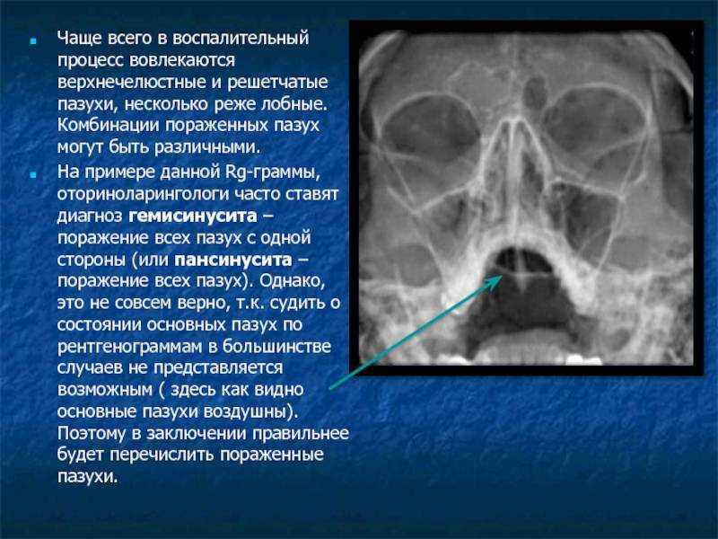 Рентген придаточных пазух носа (ппн): как и зачем делают, снимки, пример описания (расшифровки)