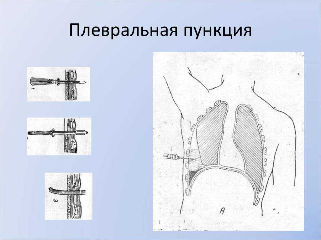 Плевральная пункция: показания, техника проведения при пневмотораксе и гидротораксе