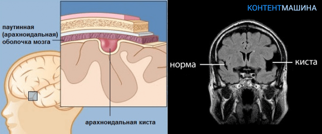 Киста сосудистого сплетения головного мозга у плода и новорожденного