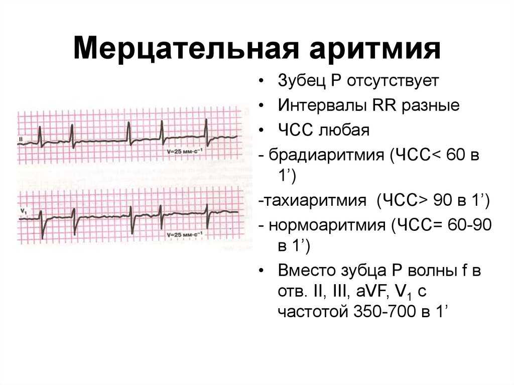 Постоянная форма фибрилляции предсердий — механизм развития, классификация