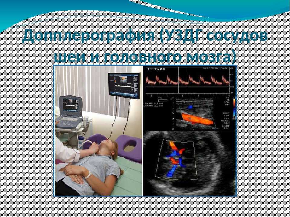 Уздг (уздс) сонных и позвоночных артерий, сделать дуплексное сканирование в клинике цэлт