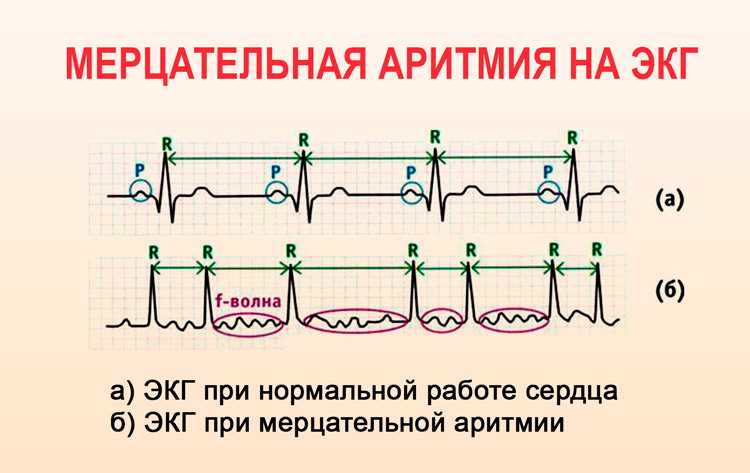 Полная характеристика желудочковой экстрасистолии: симптомы и лечение