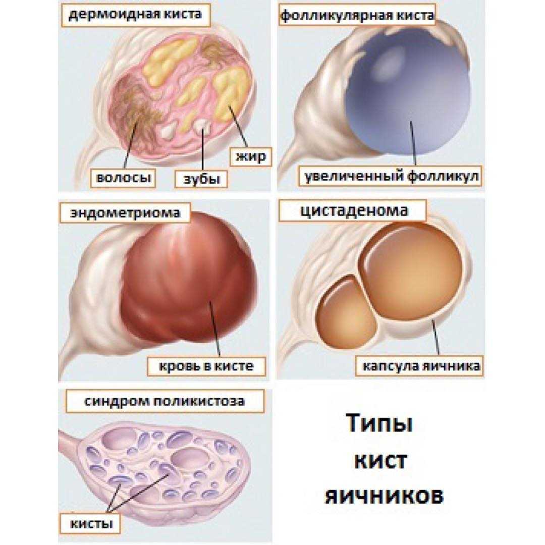 Кистозное образование левого яичника | причины и симптомы кисты