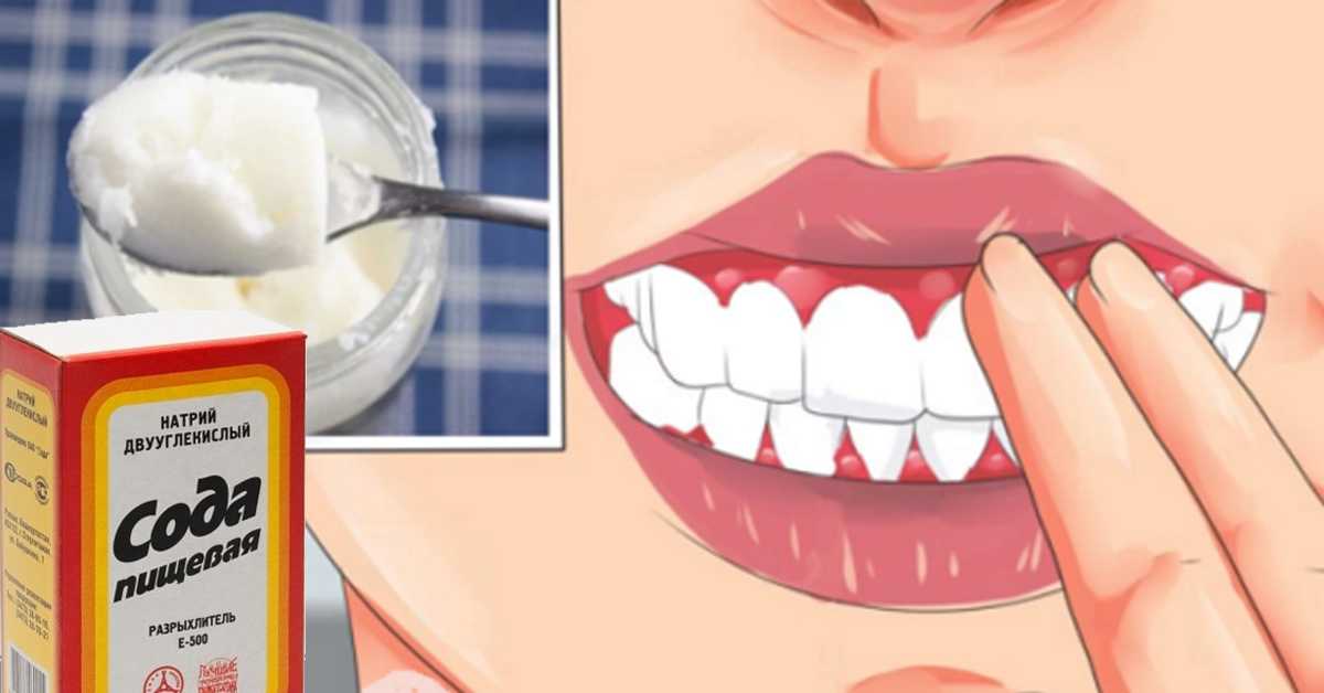 Лечение зубов при насморке и простуде: миф или реальность?
