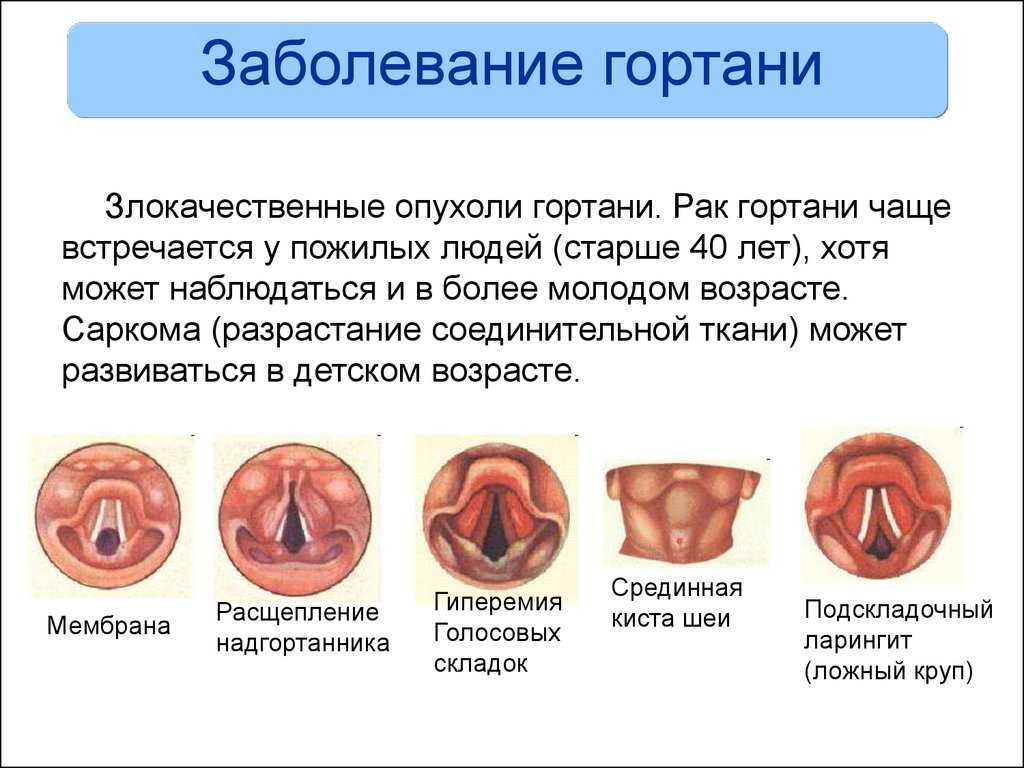 Лептотрикс это кишечная палочка