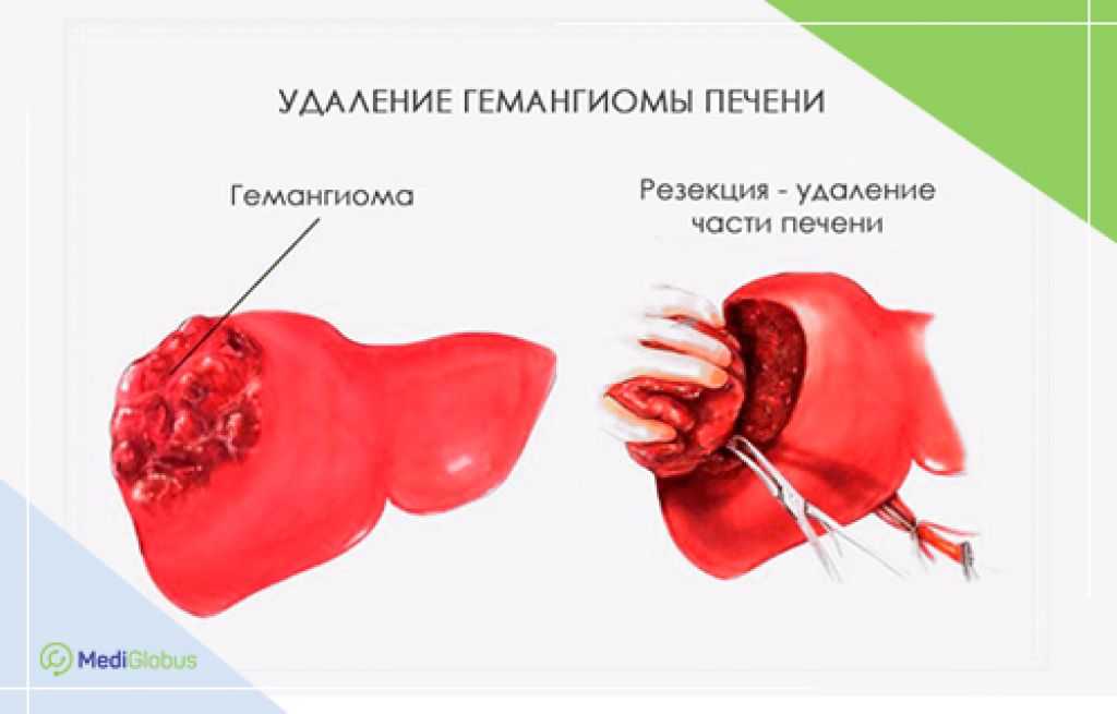 Кавернозная гемангиома — это рак  Кавернозная гемангиома  Кавернозная гемангиома — с таким диагнозом, поставленным детям сразу после рождения или во время