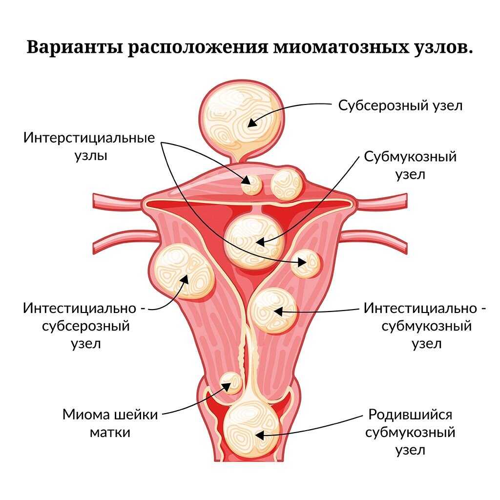 Миома матки на задней стенке матки