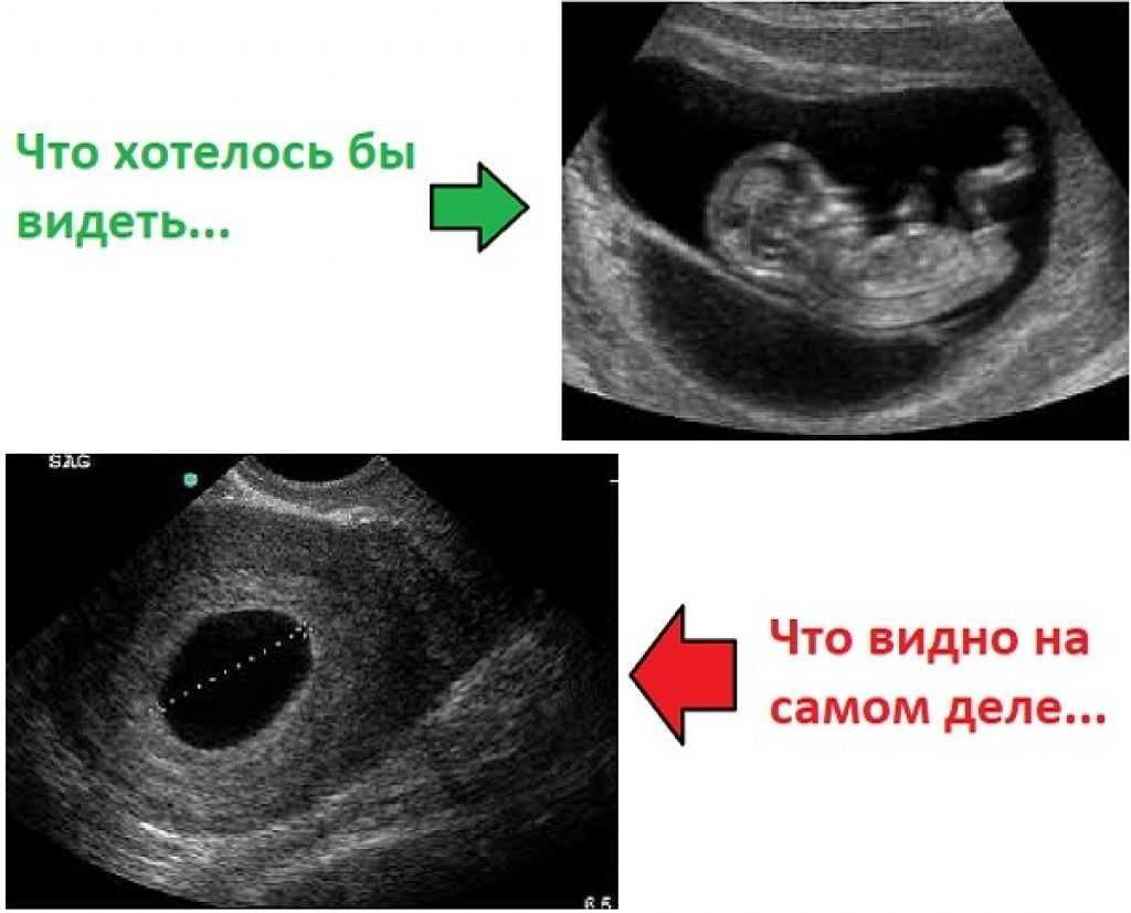 Замершая беременность — не крест на материнстве