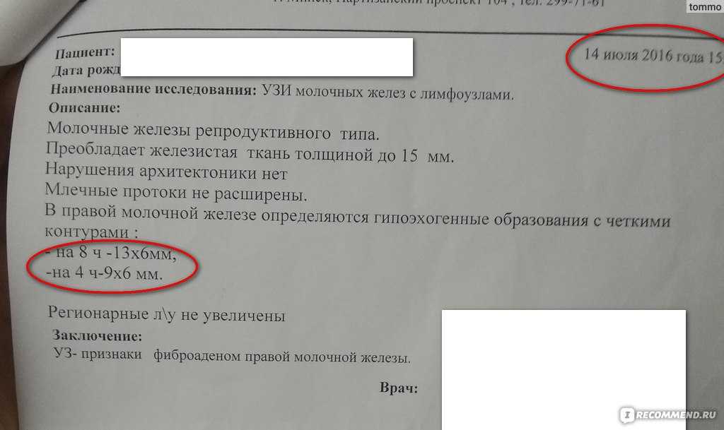 Что такое фиброаденома молочной железы, и как лечить заболевание