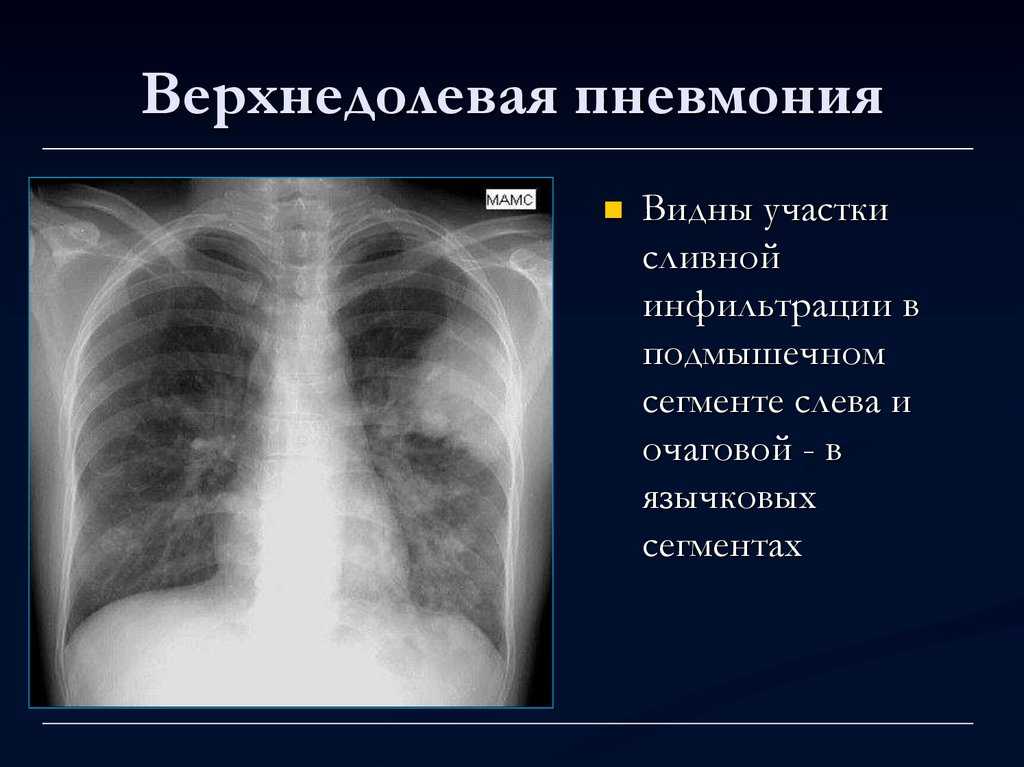 Левосторонняя пневмония: причины, клиника, диагностика, лечение