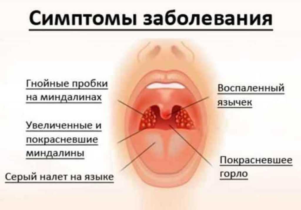 Болит горло с одной стороны: причины заболевания, лечение