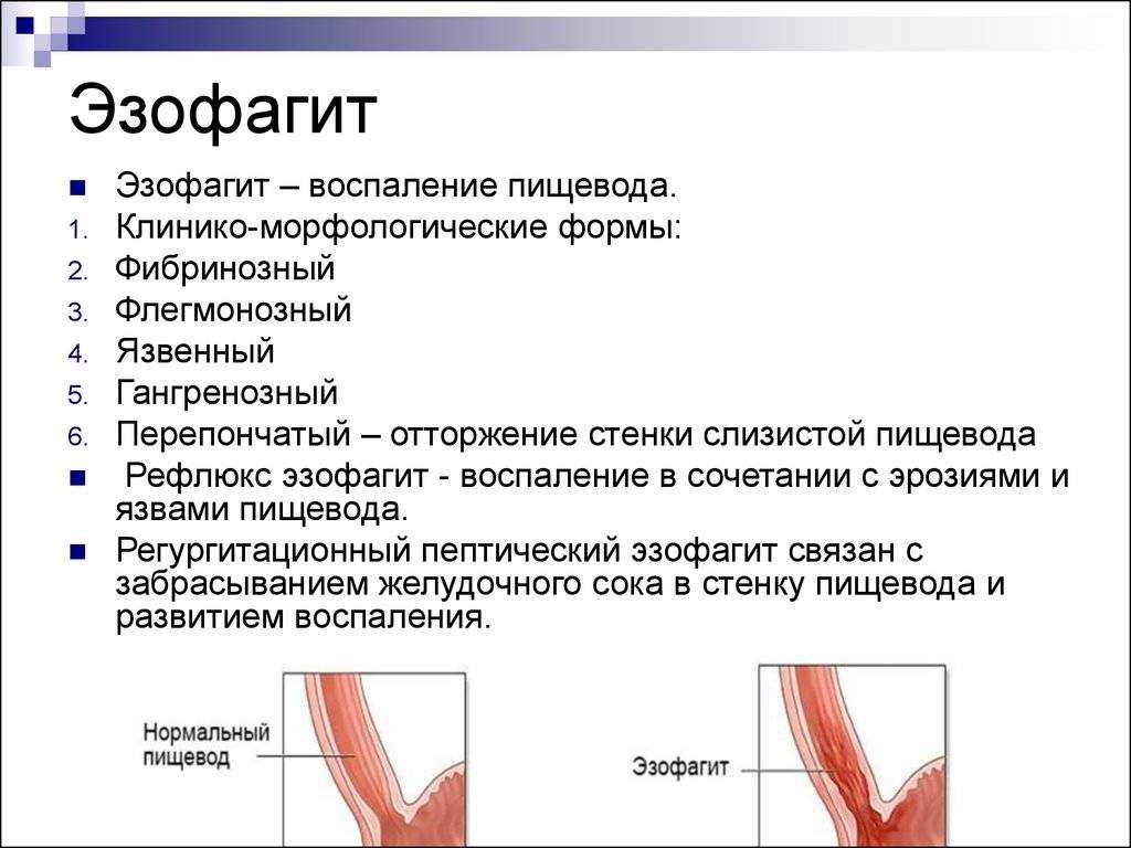 Диета и правильное питание при изжоге направлены на уменьшение ее частоты и создание условий для уменьшения воспаления слизистой желудка и пищевода Помимо купирования приступов, диета позволяет предотвратить осложнения, в частности рефлюкс-эзофагит