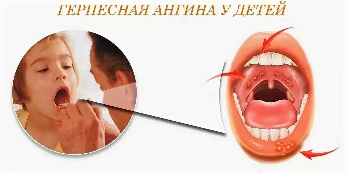 Как отличить вирусную ангину от бактериальной: признаки и симптомы