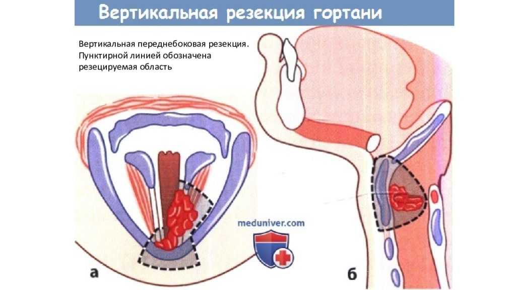 Тонзиллэктомия - удаление миндалин: как делают операцию по удалению гланд, показания, побочные эффекты