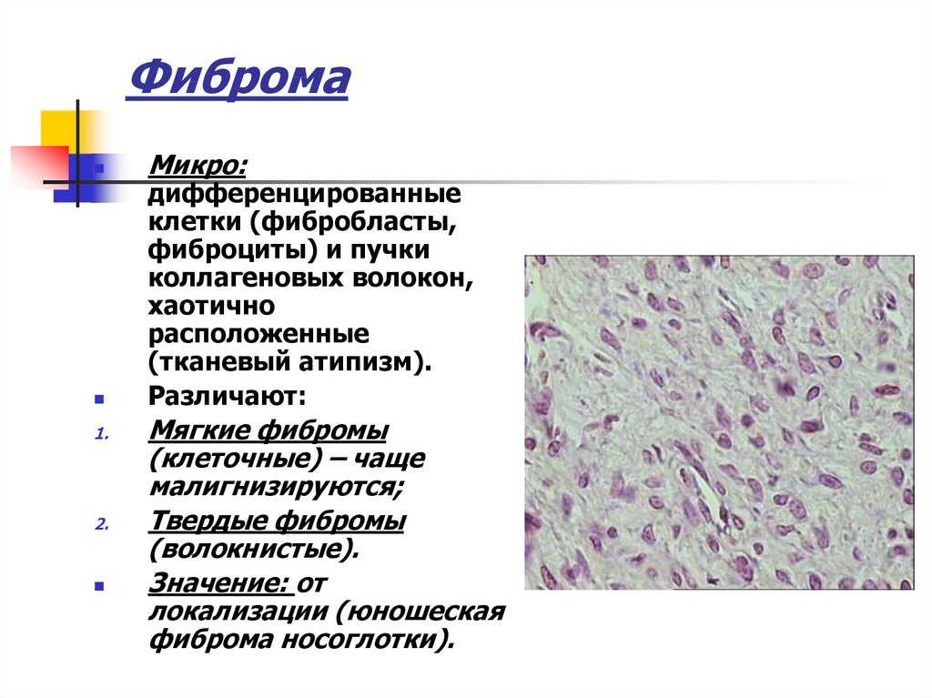 Фиброма (кожи, матки, молочной железы и других органов) – причины, виды, симптомы, диагностика и лечение, фото