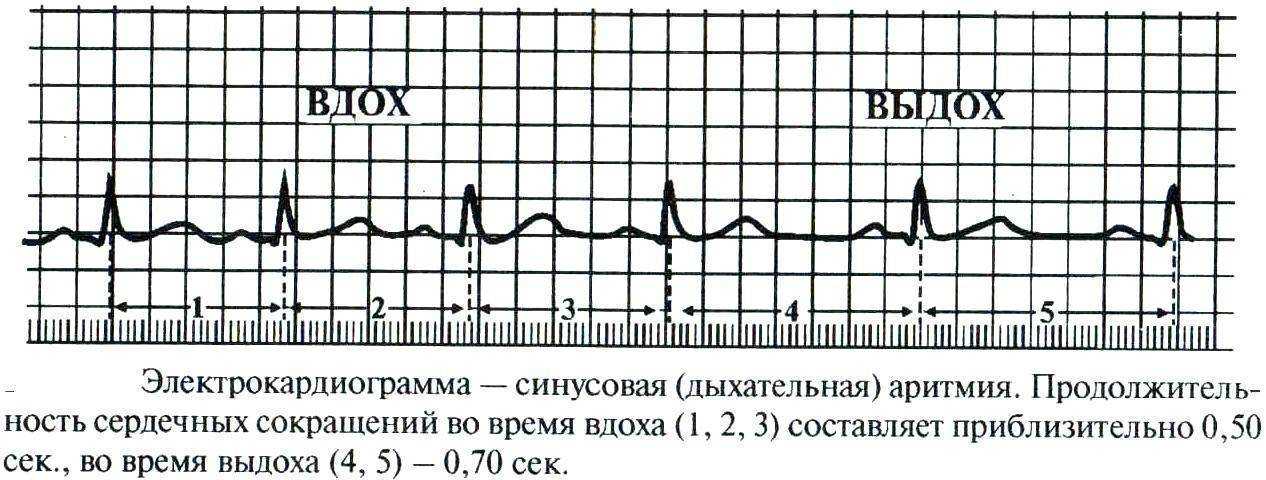 Синусовая брадиаритмия у взрослых и детей: причины и симптомы, методы лечения и прогнозы