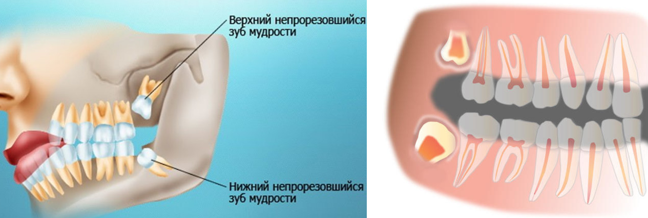 Болит зуб мудрости