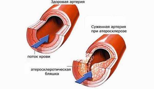 Как изменяется давление при сужении сосудов: основные причины и последствия