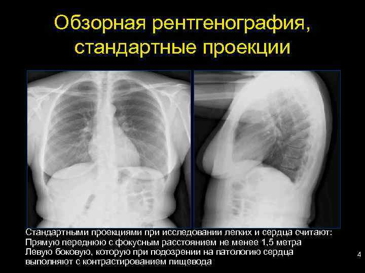 Рентген грудной клетки: что показывает рентгенография органов, чем отличается рентген от флюорографии, как часто можно делать