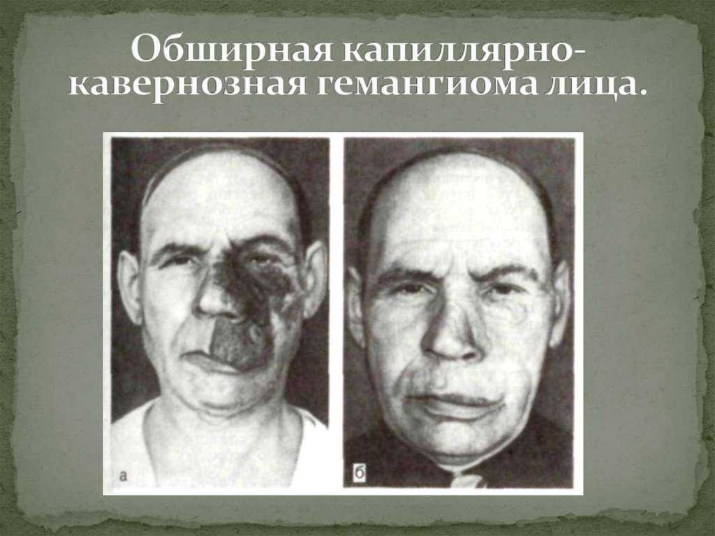 Кавернозная гемангиома - лечение каверномы