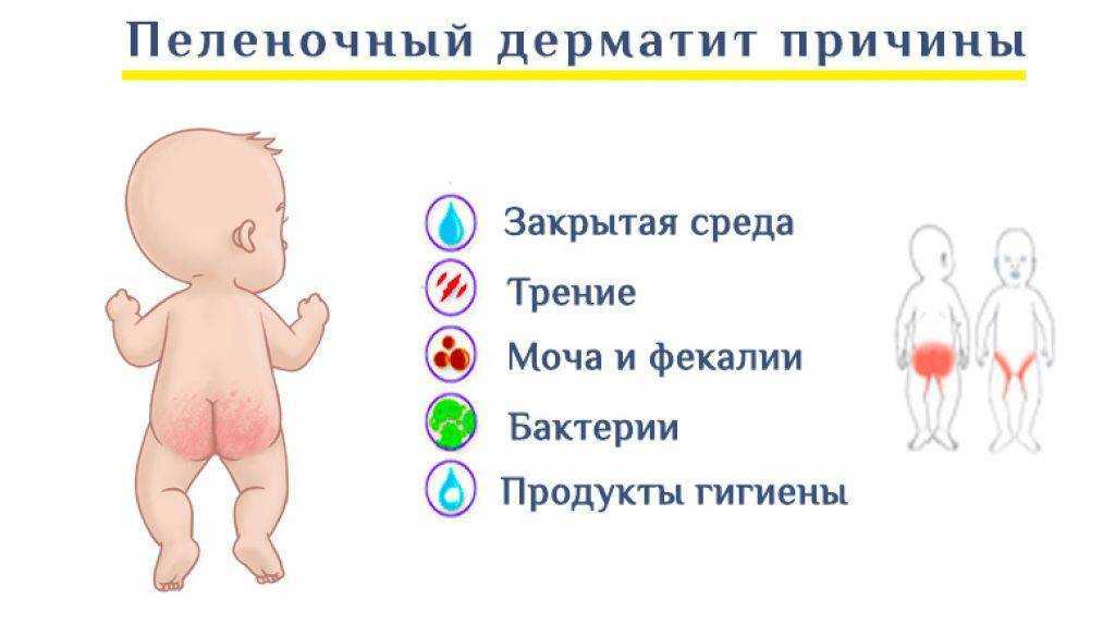 Потница у взрослых и детей: фото, симптомы, лечение