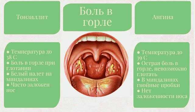 Ангина при грудном вскармливании: чем лечить | s-voi.ru