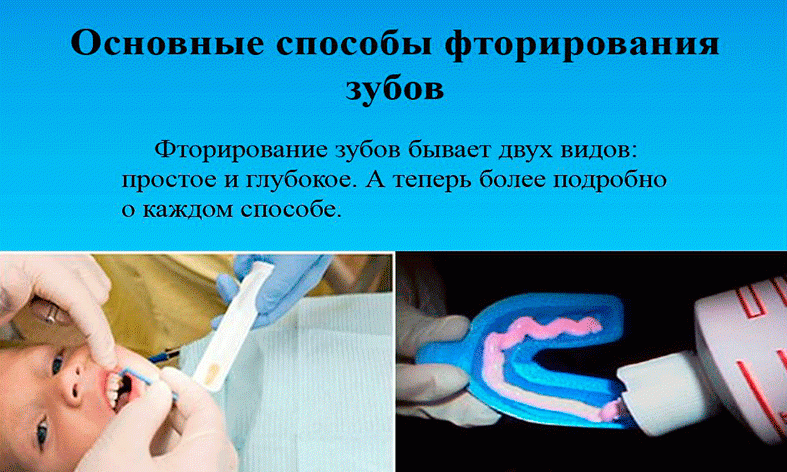 Глубокое фторирование эмали зубов: что это такое, как делается