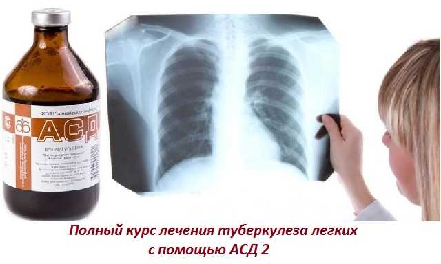 Лечение туберкулеза народными средствами в домашних условиях