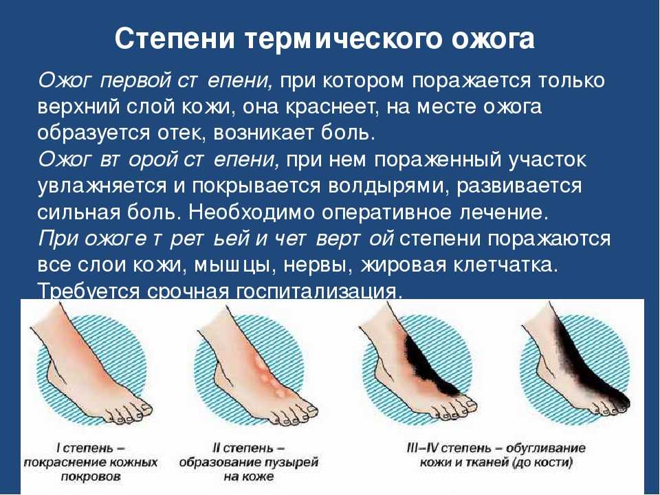Обморожение